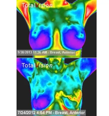 DEXA Scan Charleston SC